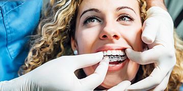 woman being fitted for clear aligner braces