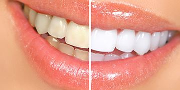 teeth whitening before and after